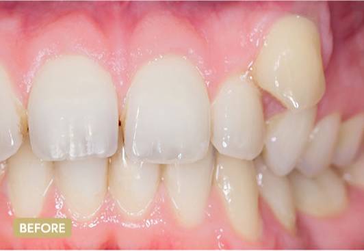 Invisalign-BeforeAfter2