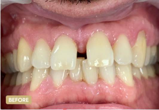 Invisalign-BeforeAfter3