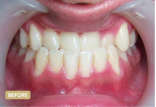 Invisalign-BeforeAfter4