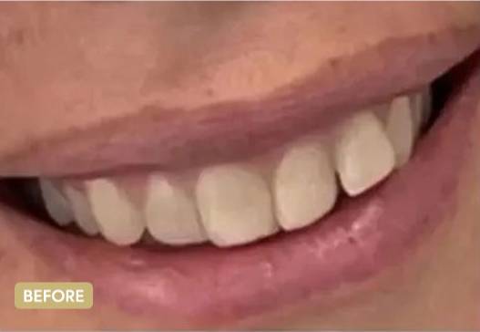 Invisalign-BeforeAfter5