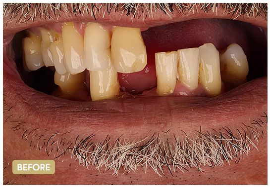 dental-Implant-before-5