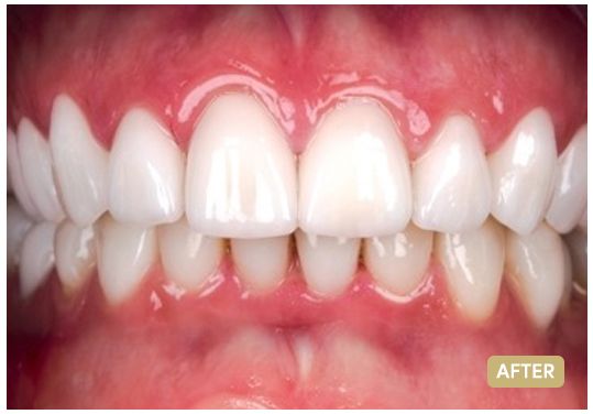 veneers-1-the-clinic-after