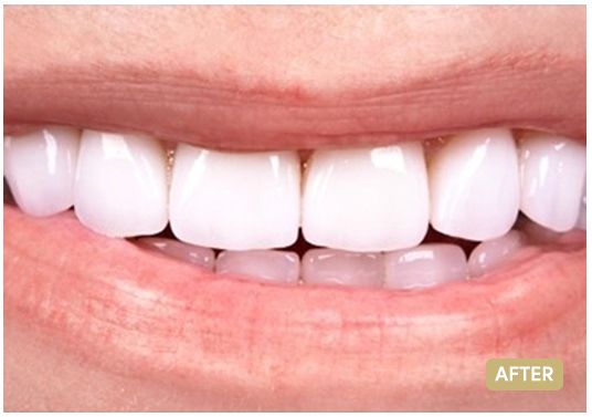 veneers-3-the-clinic-after