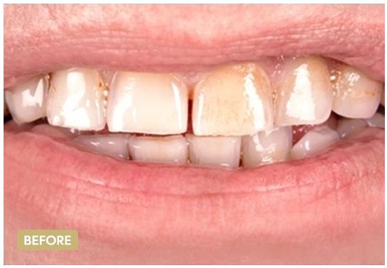 veneers-3-the-clinic-before