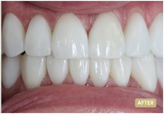 veneers-4-the-clinic-after