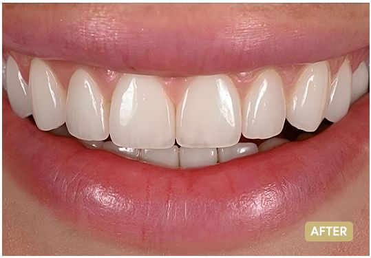 veneers-5-the-clinic-after