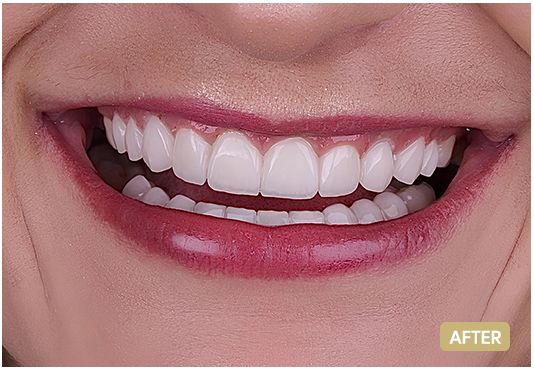 Emax-veneers-after-1