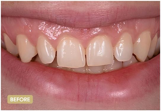 Emax-veneers-before-2