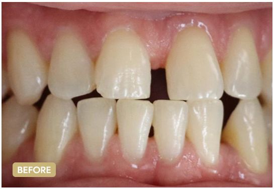 Emax-veneers-before-3