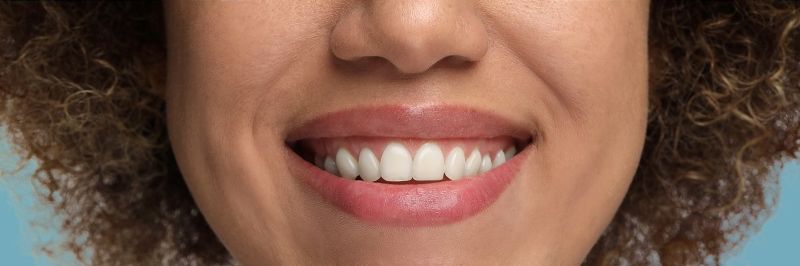 Woman,Showing,Teeth,Before,And,After,Whitening,,Collage