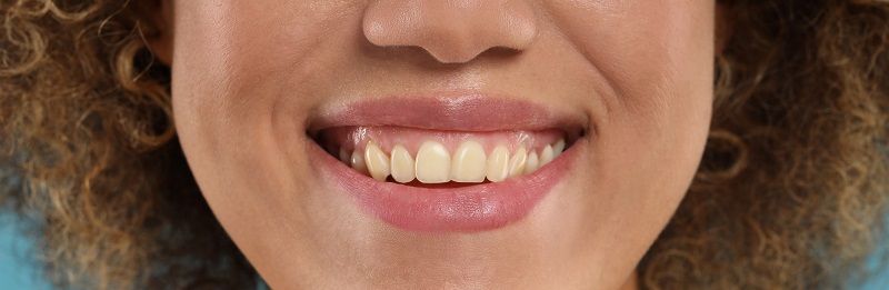 Woman,Showing,Teeth,Before,And,After,Whitening,,Collage