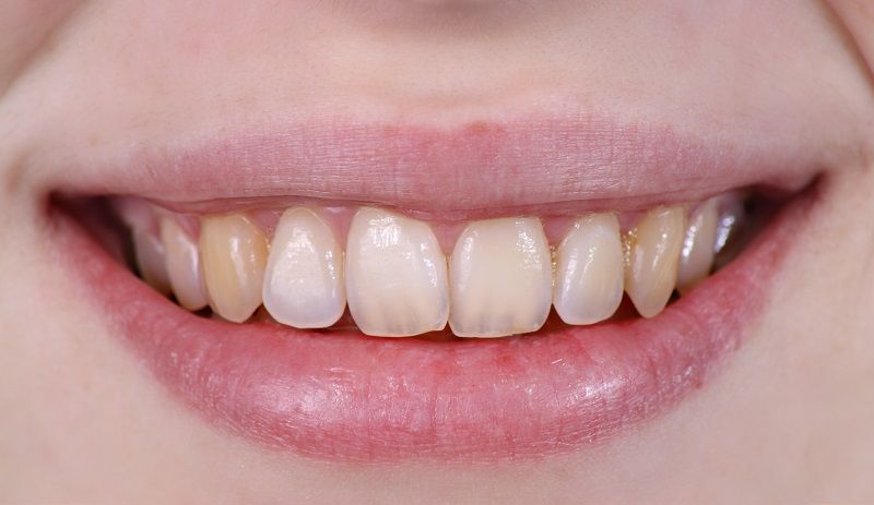 Before,And,After,Dental,Treatment